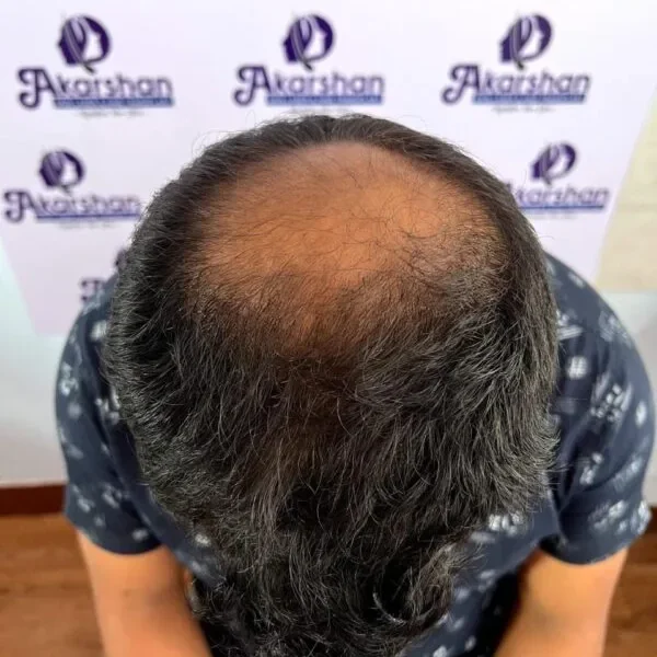 hair-transplnat-before-photo-600x800