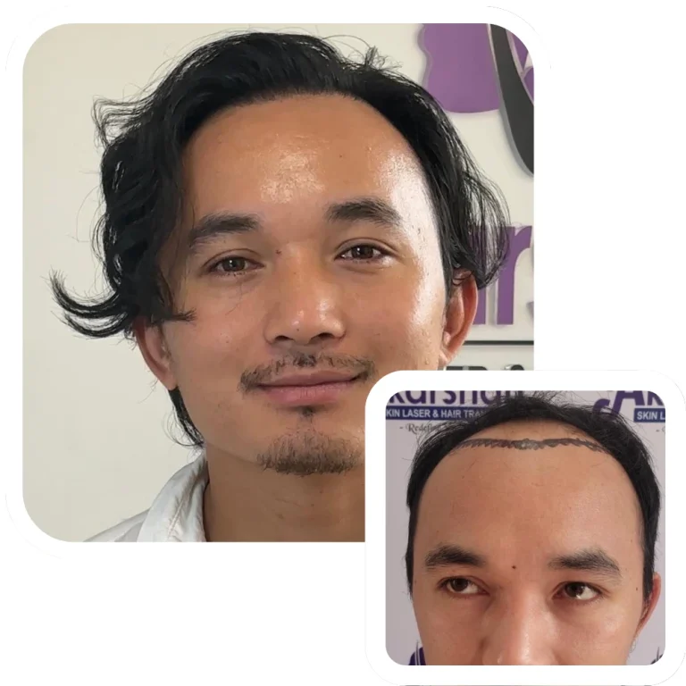 Hair transplant result 3200 graft dht before and after