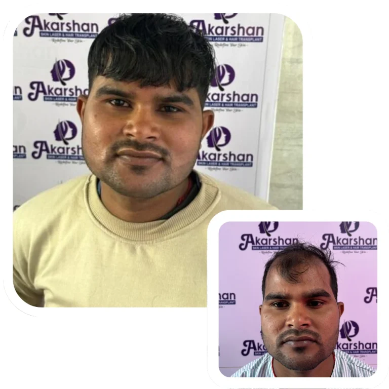 Hair transplant before and after 4500 graft fue