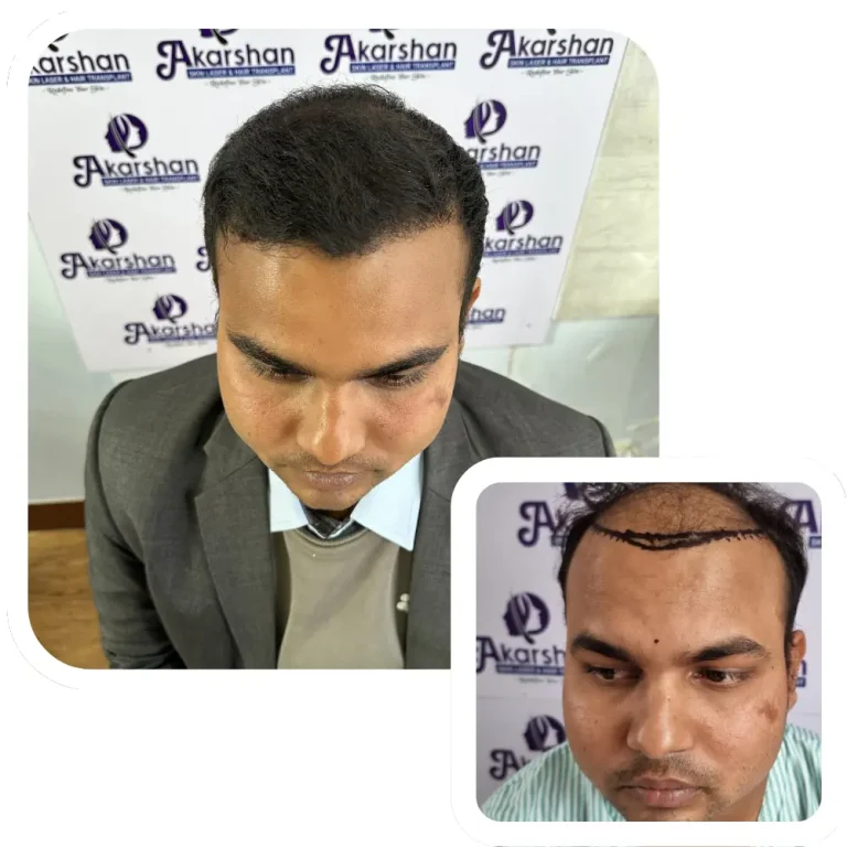 hair transplant before and after 4000 graft fue