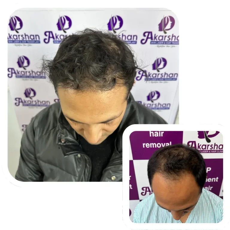 hair transplant before and after 3500 graft fue result
