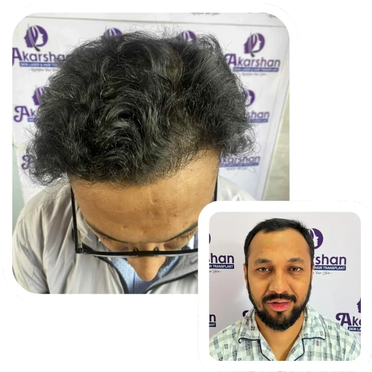 Hair transplant result 2000 graft fue before and after