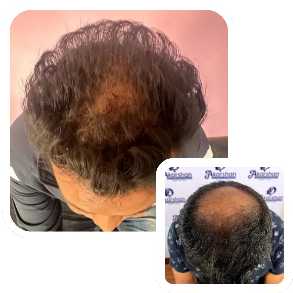 ht website before and after crown area