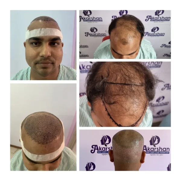 madhusudan 4000 graft