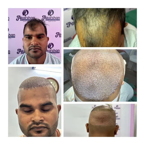 matrika 4500 graft