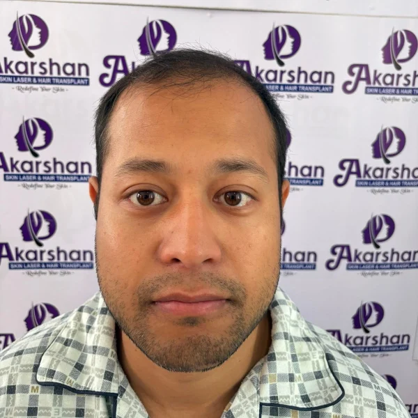 nicolas hair transplant 4500 graft dht before surgery day