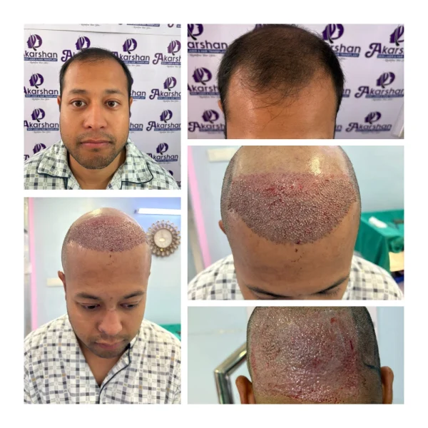 nicolas hair transplant 4500 graft dht surgery day