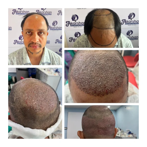 nirmal adhikari ht 4500 grafts fue