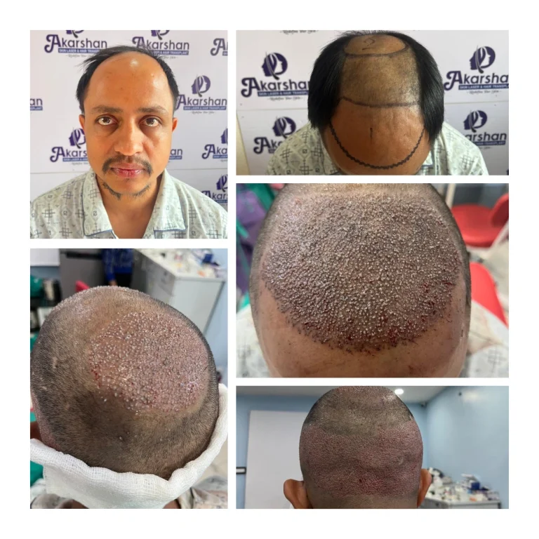 nirmal adhikari ht 4500 grafts fue surgery day