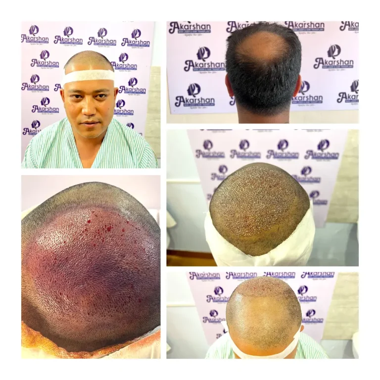 FUE Hair Transplant: Crown Area Restoration surgery day