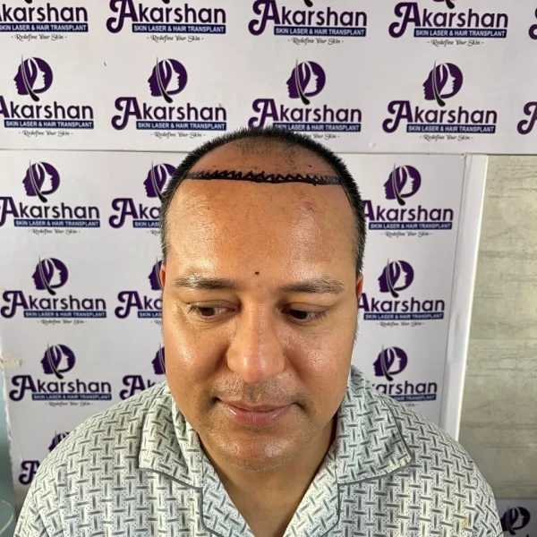 radhakrishna hair transplant 3500 graft dht before surgery day