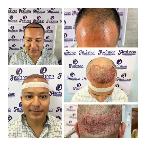 radhakrishna hair transplant 3500 graft dht surgery day