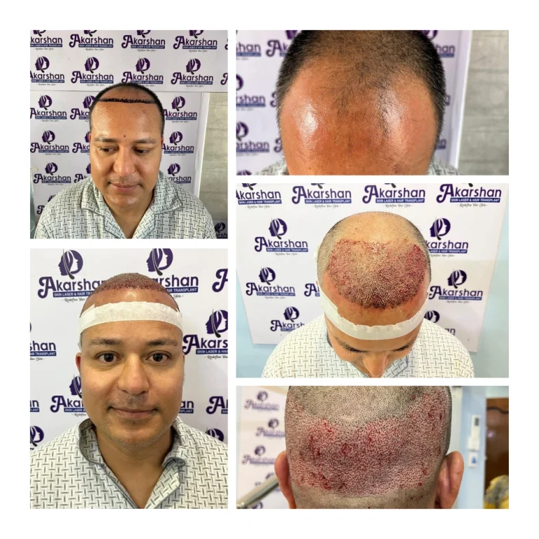radhakrishna hair transplant 3500 graft dht surgery day