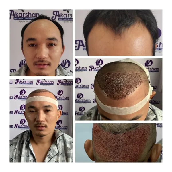 rojip lama 3200 grafts