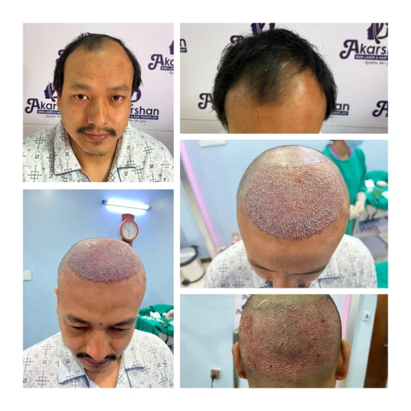 santosh shrestha ht 3500 grafts DHT