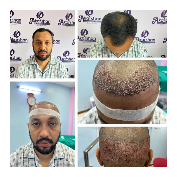 subodh khadka ht 2000 grafts