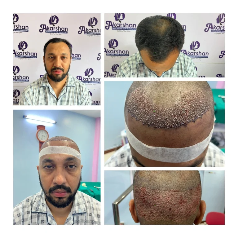 subodh khadka ht 2000 grafts surgery day