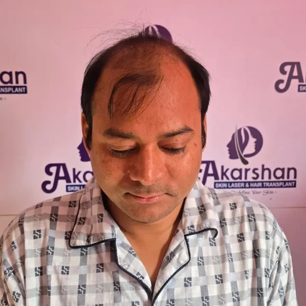 Nirdhoj Thapa hair transplant 4000 graft fue before surgery day