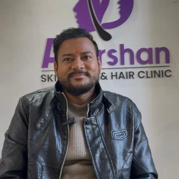 Nirdhoj Thapa hair transplant result 4000 graft fue (1)