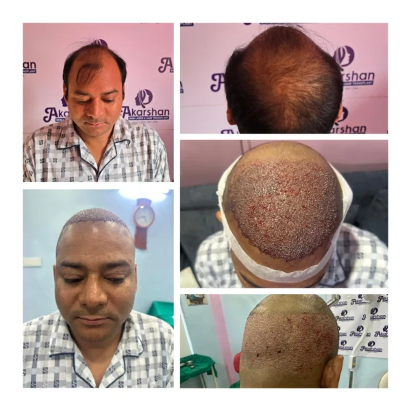 Nirdhoj Thapa hair transplant result 4000 graft fue (2)