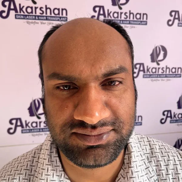 Santosh Kumar hair transplant high density 5000 graft DHT before surgery day