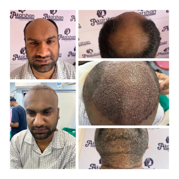 Santosh Kumar hair transplant high density 5000 graft DHT surgery day