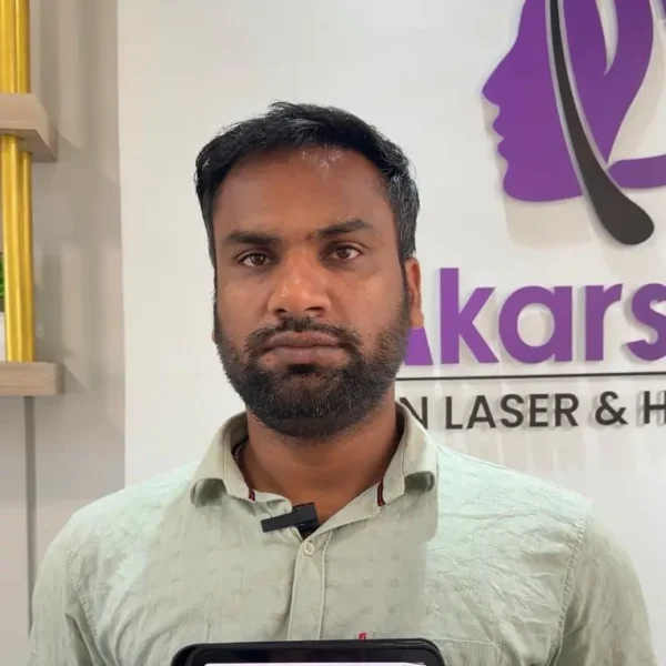 Santosh Kumar hair transplant high density result 5000 graft DHT