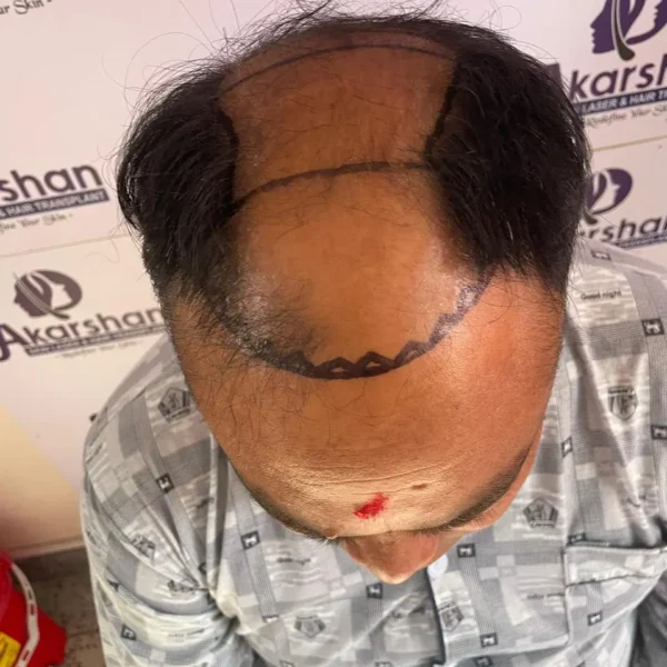 Shyam shrestha hair transplant 4000 graft fue before surgery day