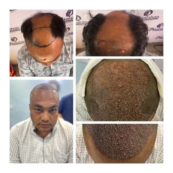 Shyam shrestha hair transplant 4000 graft fue surgery day