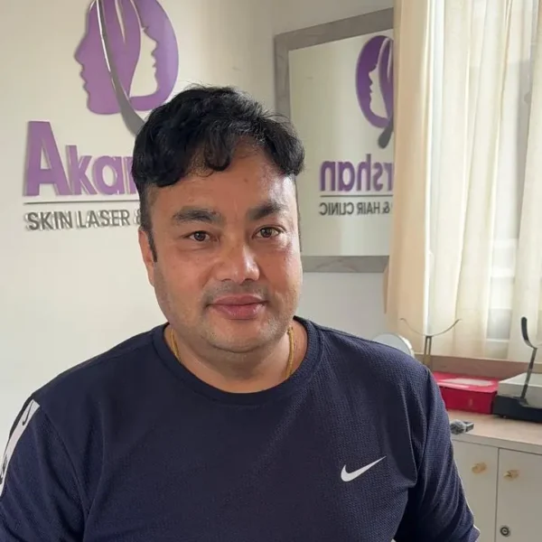 Shyam shrestha hair transplant result 4000 graft fue