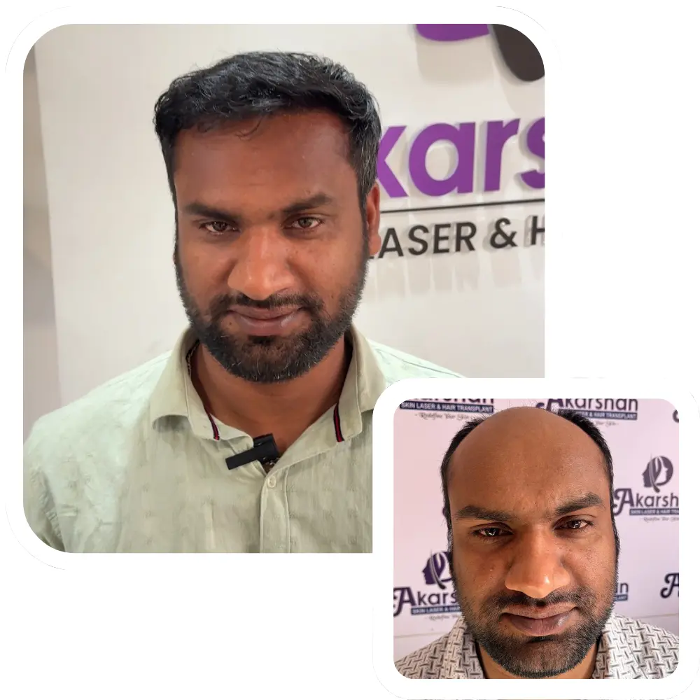 hair transplant high density result 5000 graft