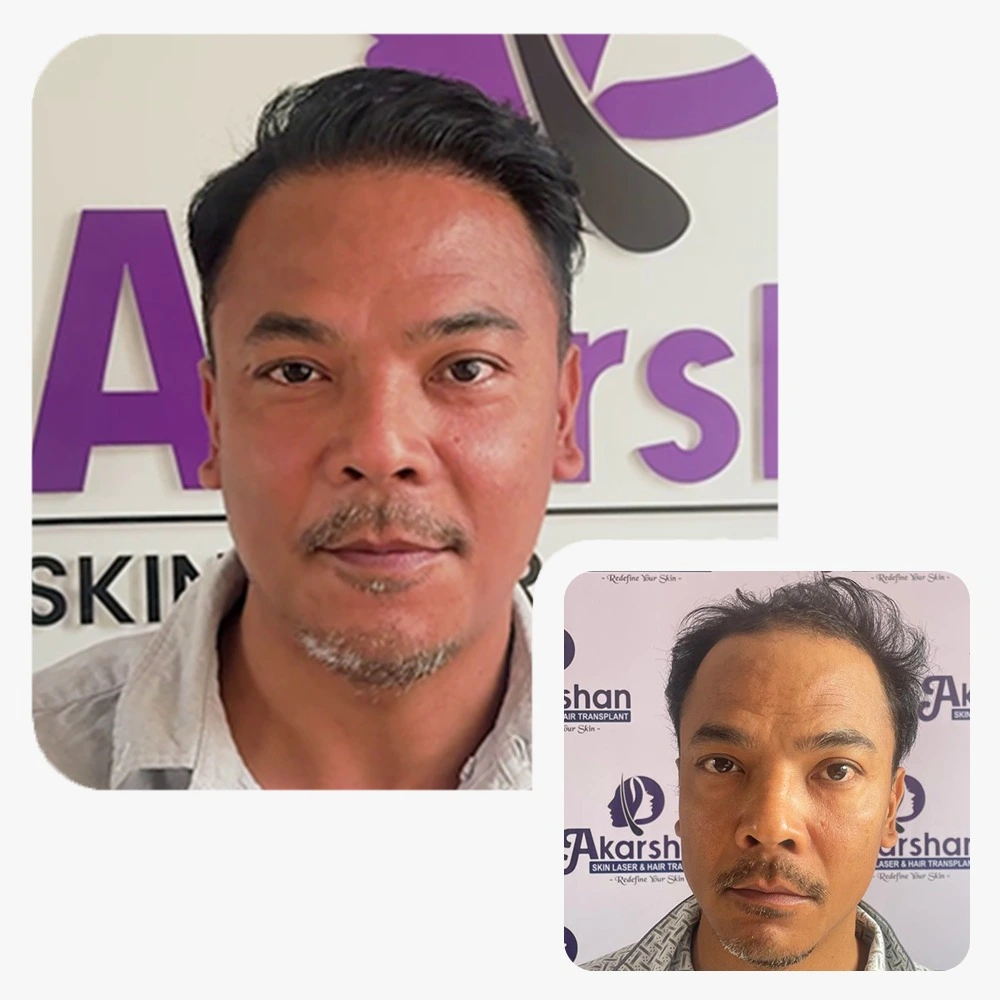 hair transplant result 2800 graft