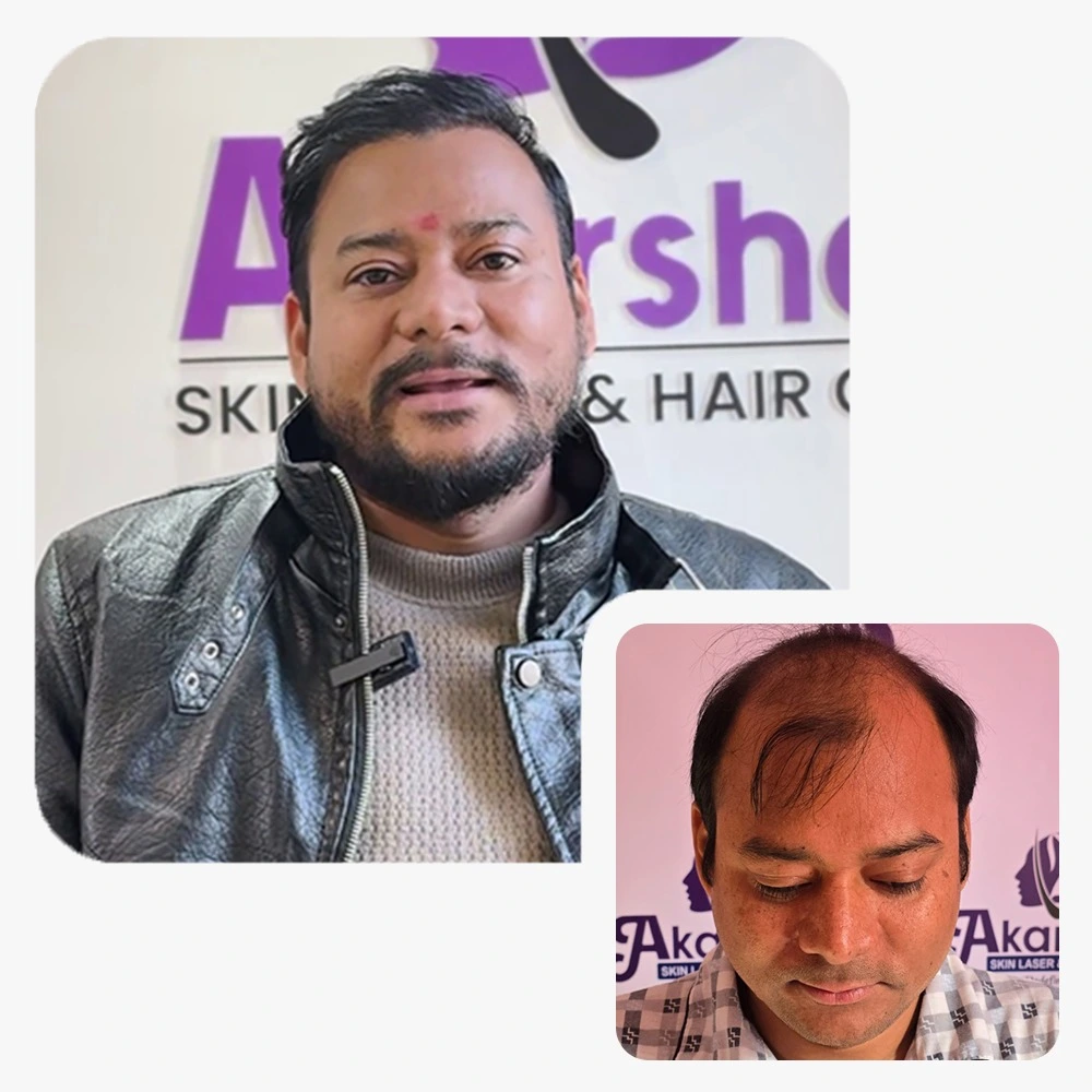 hair transplant result 4000 graft