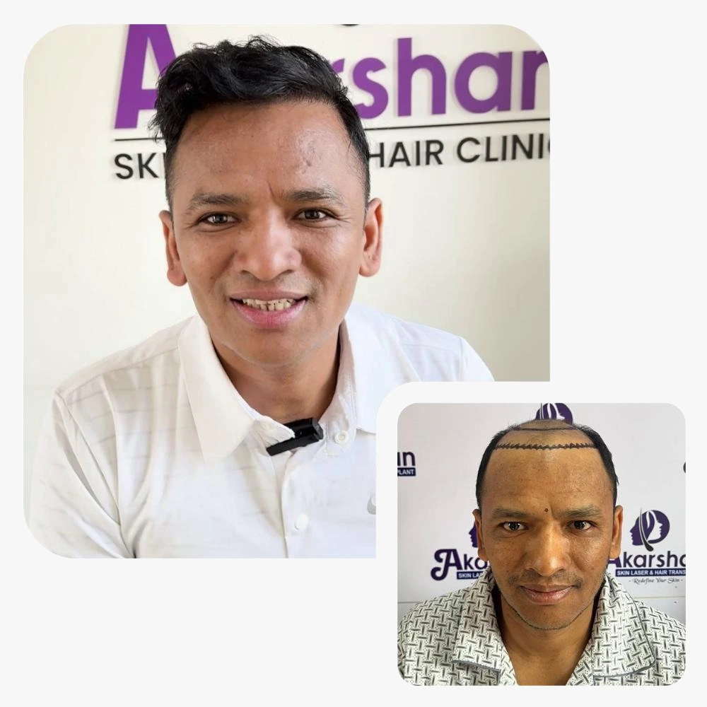 hair transplant result 4500 graft