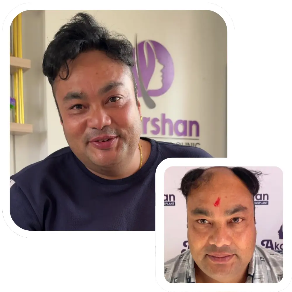 hair transplant shyam ji result 4000 graft
