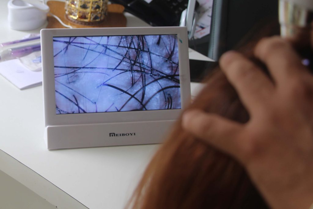 doctor observing scalp via trichoscope